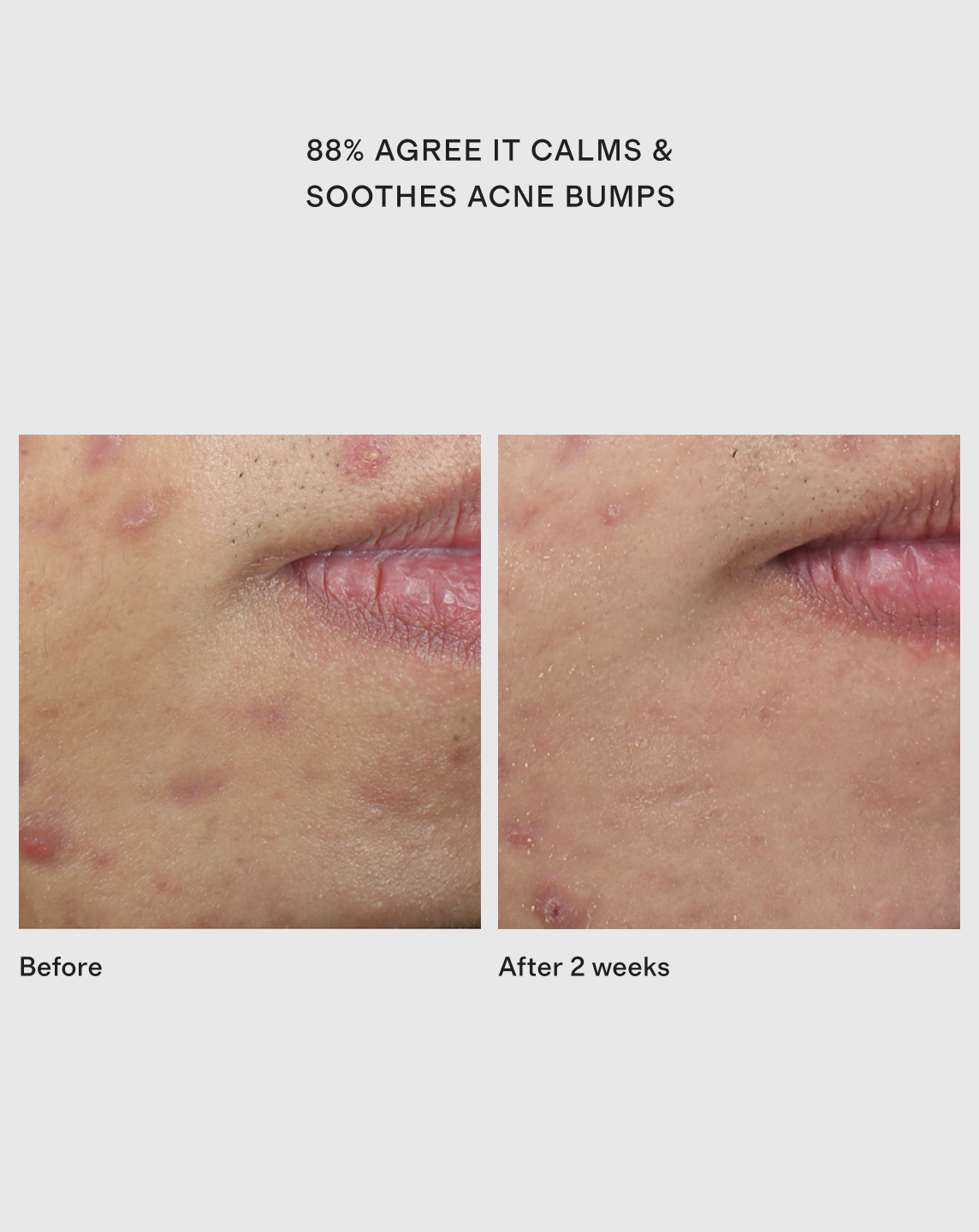Murad DeepReliefAcneTreatment 03-1